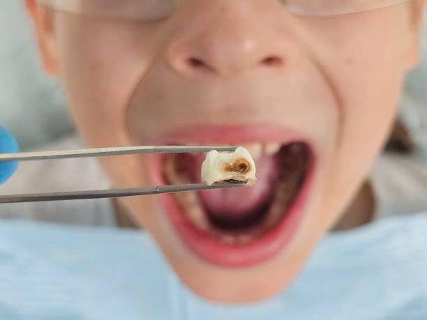 Best Emergency Dental Filling Replacement  in Silver Bay, MN